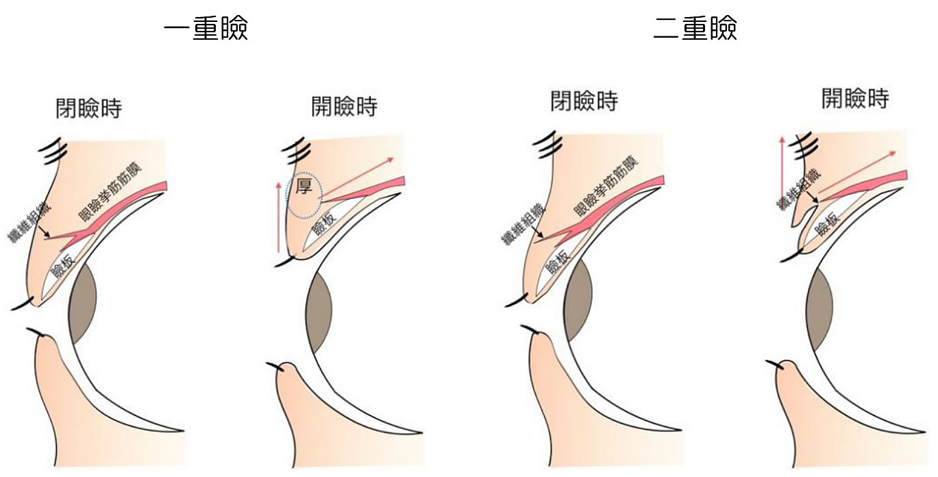 一目瞼と二重瞼
