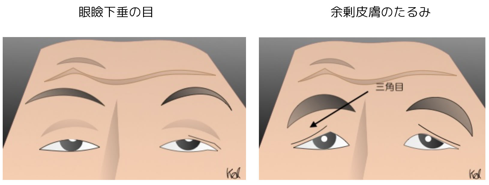 まぶたのたるみ