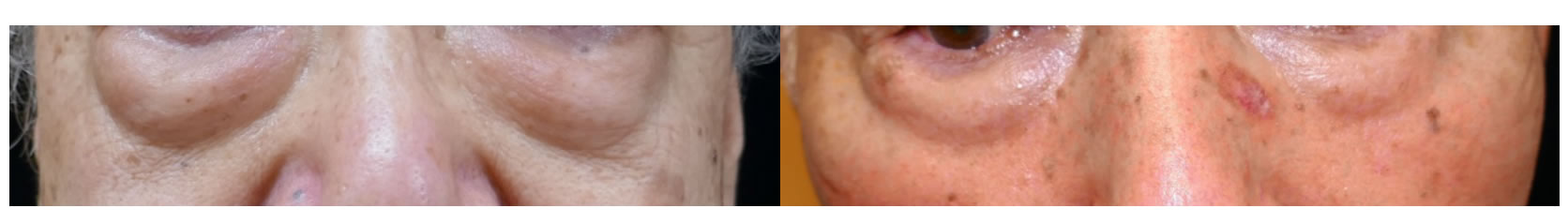 下眼瞼のたるみ