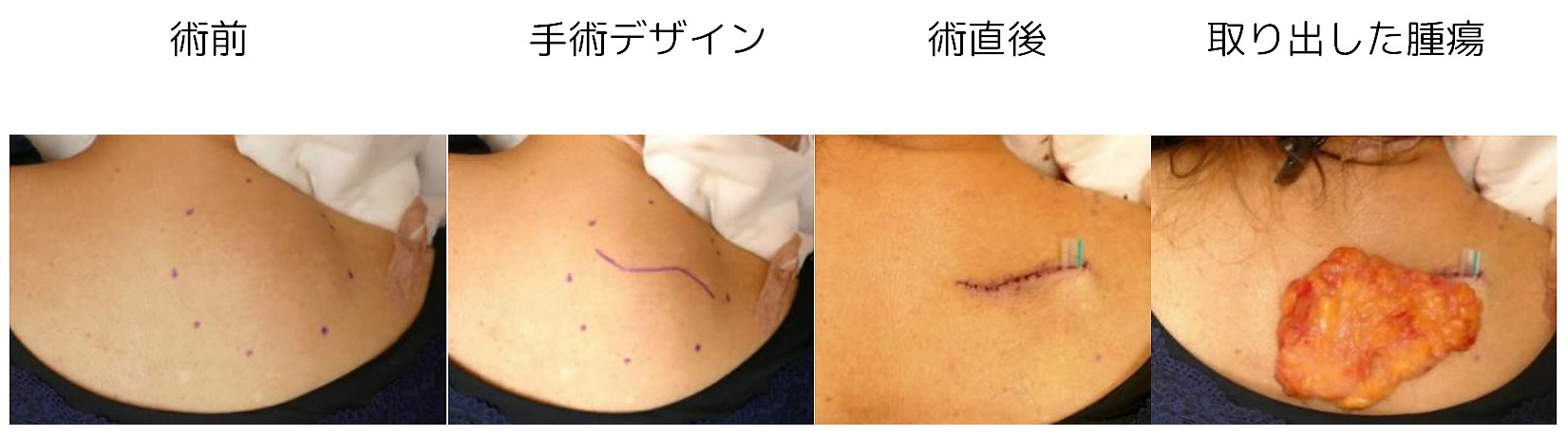 脂肪腫の切除例