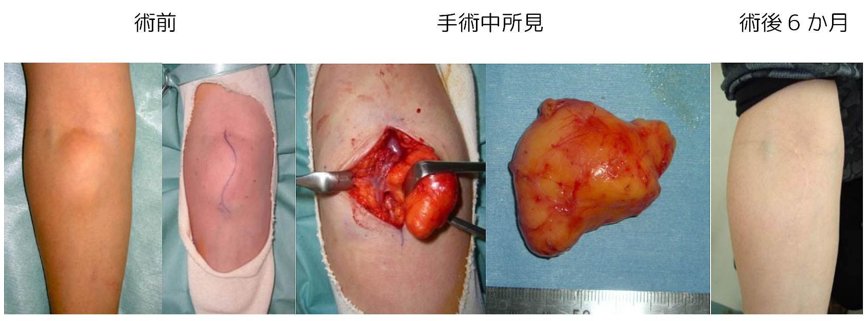 脂肪腫の切除例3