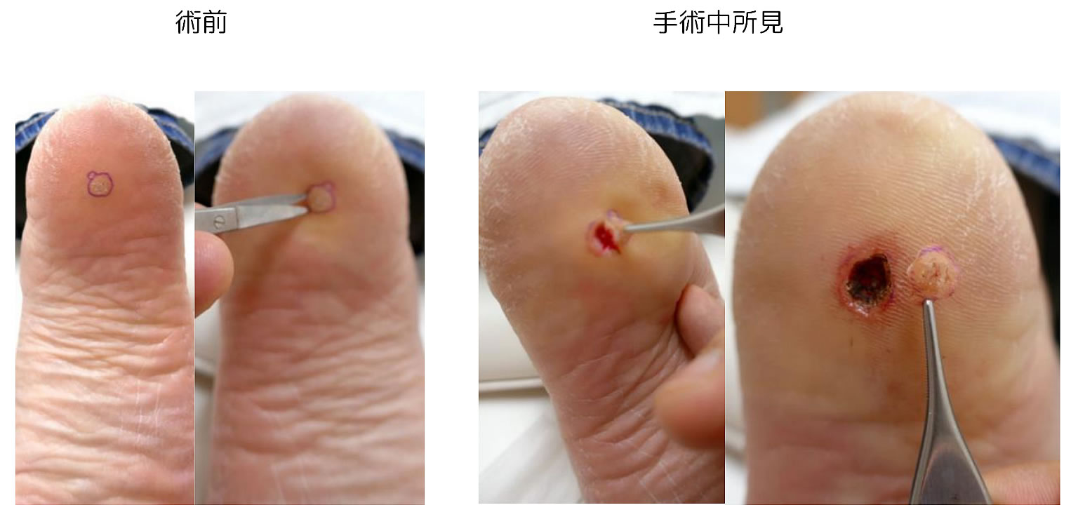 江川のいぼ剥（はぎ）法