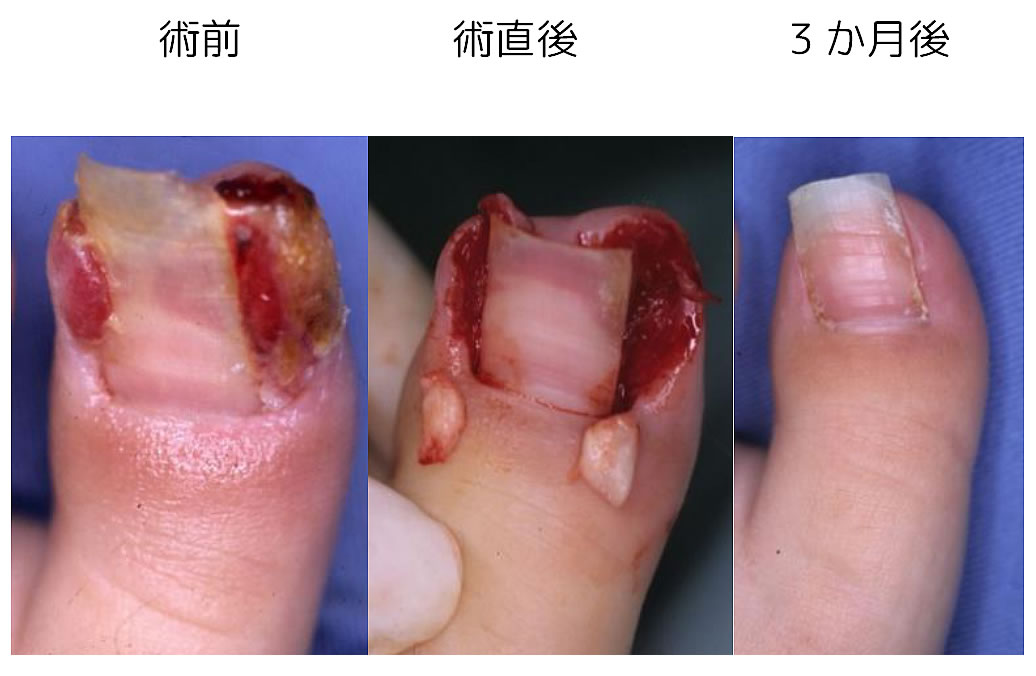 陥入爪手術の例