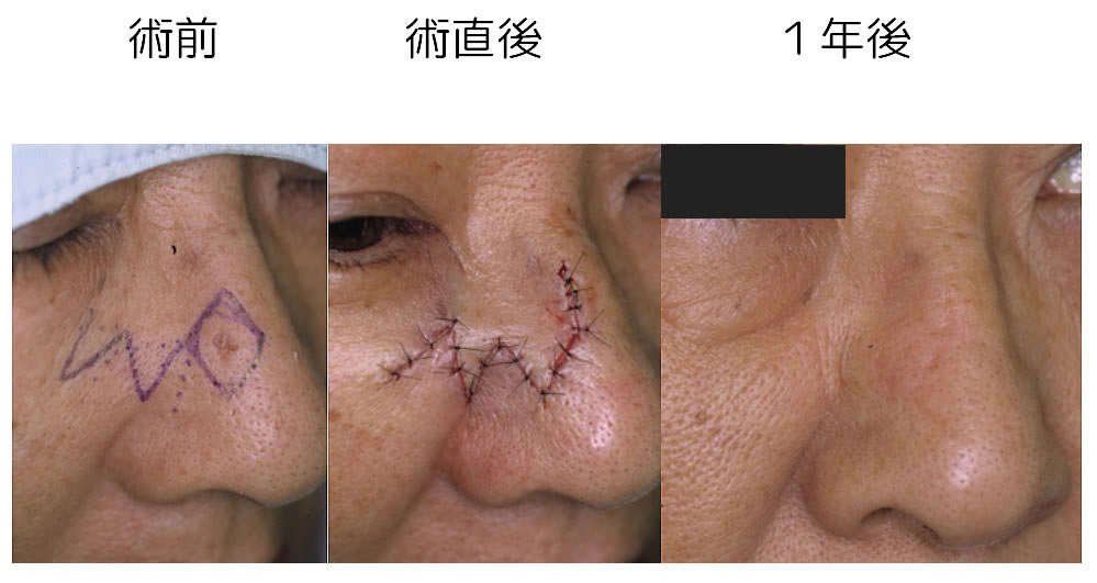 基底細胞癌を２葉皮弁で再建した例