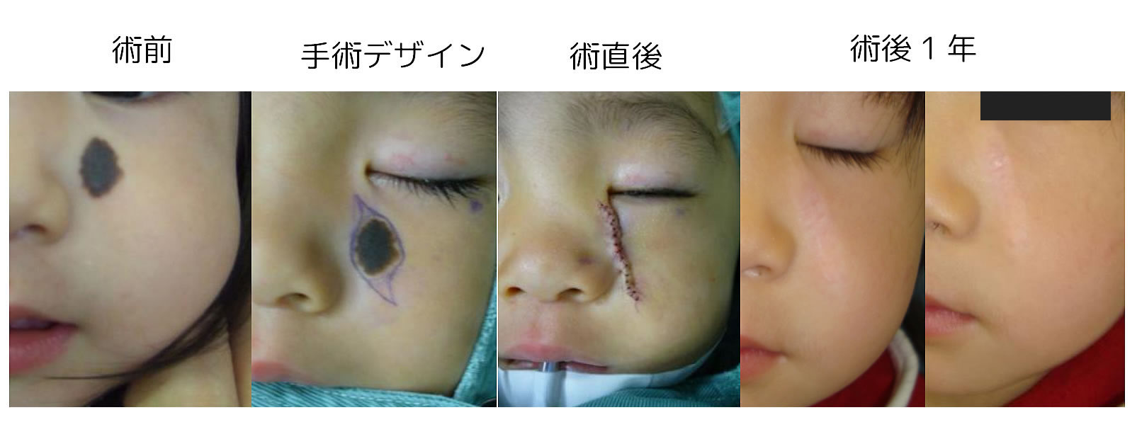 黒子の切除例１（小児）