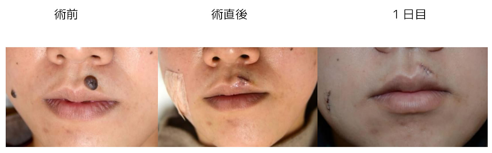 黒子の切除例２