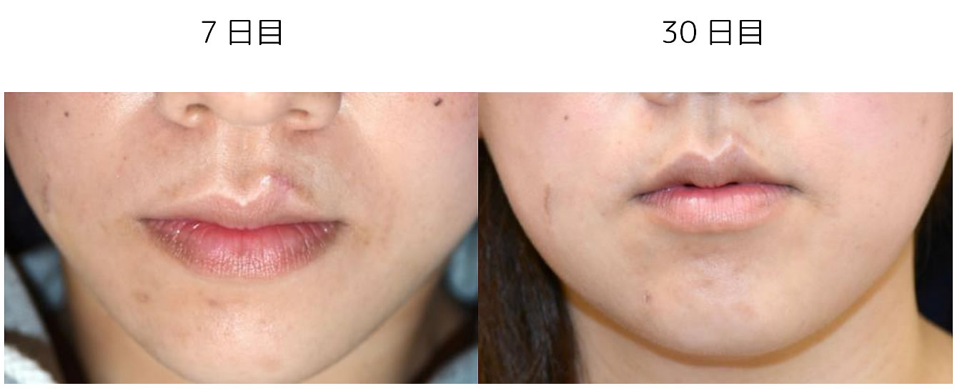 黒子の切除例２