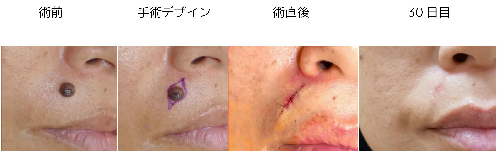 黒子の切除例