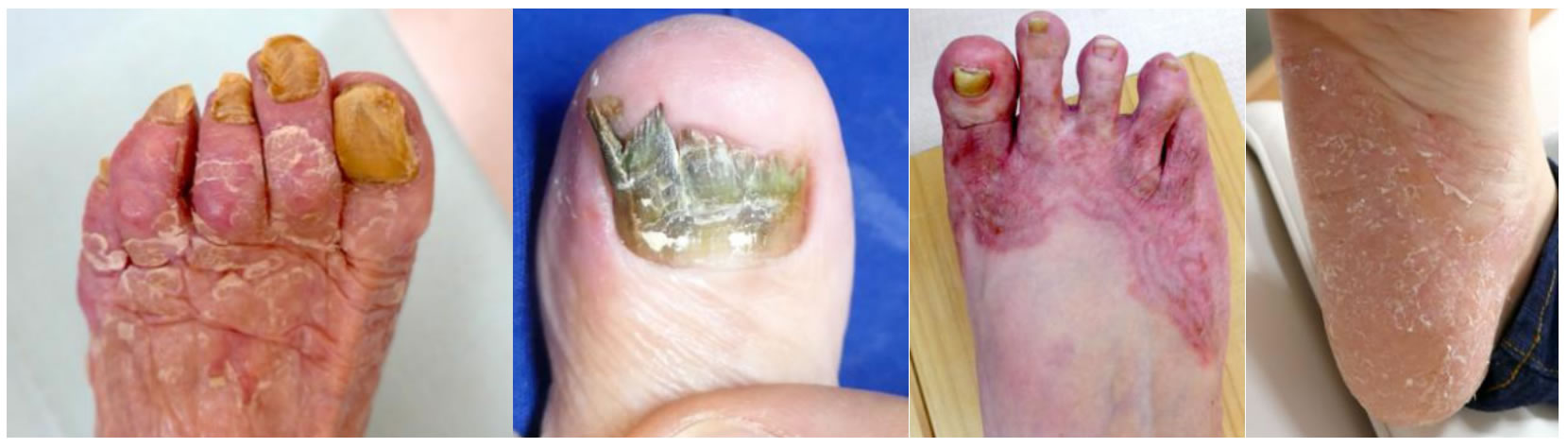 水虫・爪白癬・皮膚真菌症