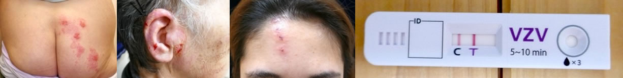 帯状疱疹・ヘルペス
