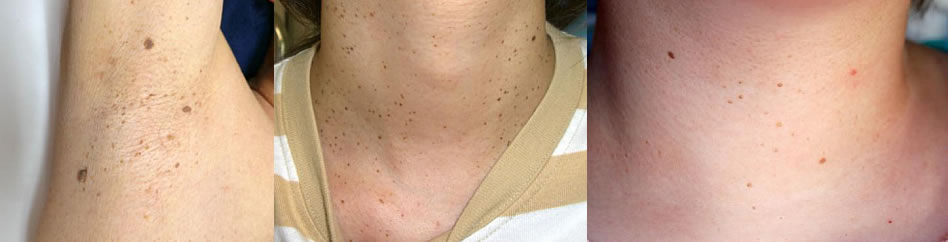 首や腋の下にいっぱいできるブツブツいぼ