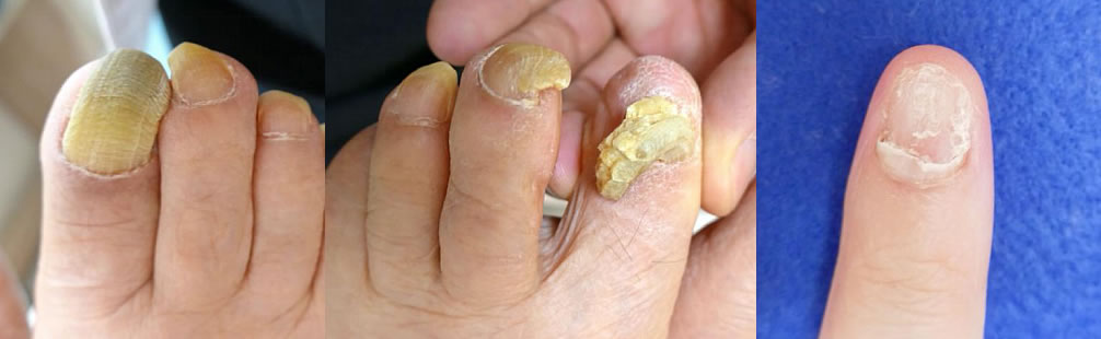 鉤彎爪・肥厚爪・その他の爪の変形