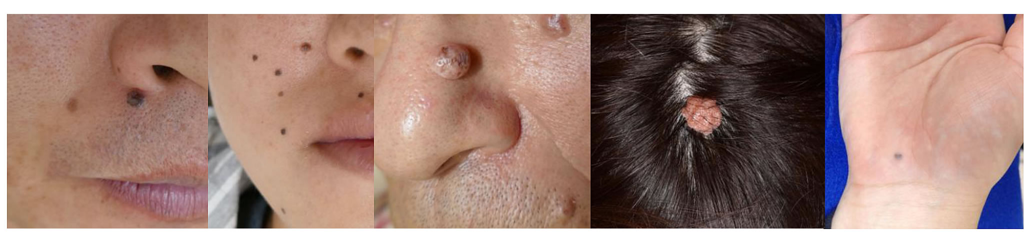 色々なほくろの形態