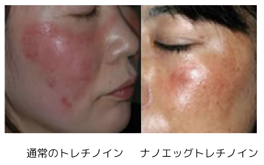ナノエッグトレチノイン