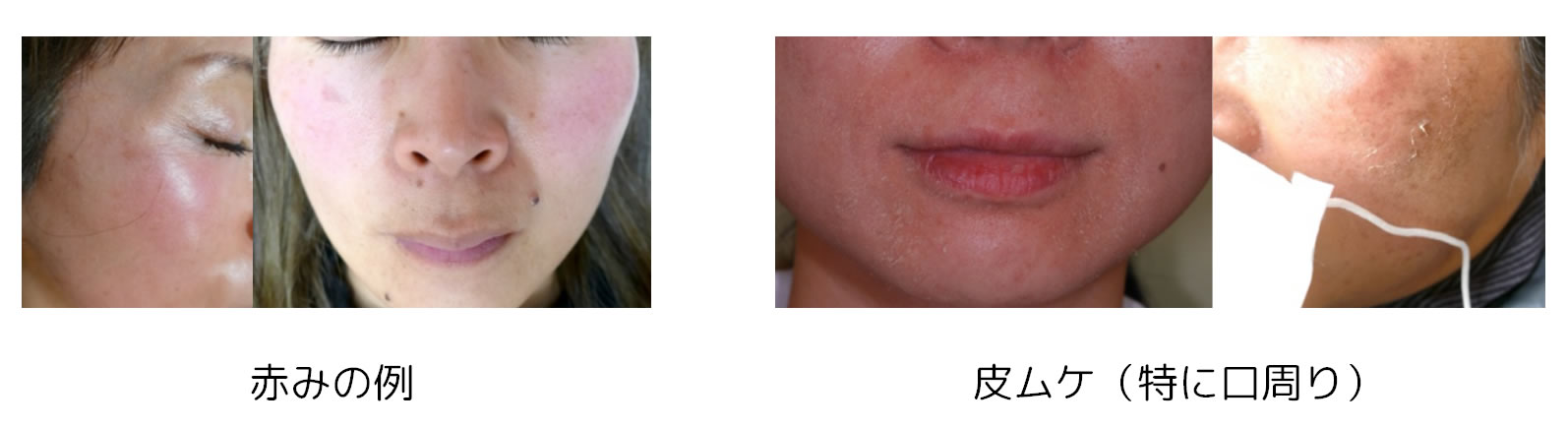 ZOスキンのダウンタイムの例